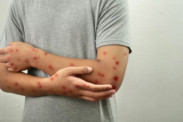 Mpox ainda demanda atenção constante, alerta médica