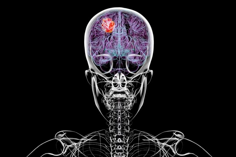 Mudanças na dieta podem potencializar tratamento de tumor cerebral