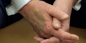 Makeup covers a bruise on the back of U.S. President Donald Trump's hand.