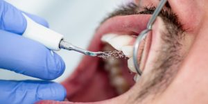 Plaque remover close-up