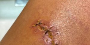 de mordida de jacaré • Instagram/ Bella Campos