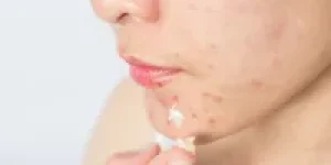 acne-e1707416058570