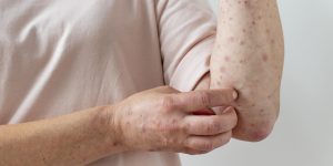 alergia-cutanea-no-braco-de-uma-pessoa