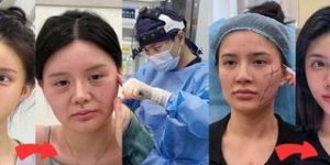 Transformação de Juju do Pix após cirurgia de remoção de óleo mineral