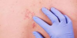 herpes-zoster-diagnostico