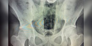 Riscos de objetos presos no ânus exigem atenção médica urgente