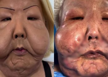 Rosto de Juju do Pix após primeira cirurgia. (Reprodução)