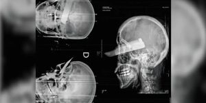 Mulher recebe facada no olho em tentativa de feminicídio em SC