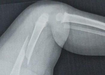 Investigação sobre fratura de fêmur em criança de 1 ano no Paraná