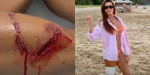 s da mordida de turbarão sofrido em Fernando de Noronha