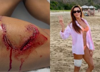 s da mordida de turbarão sofrido em Fernando de Noronha