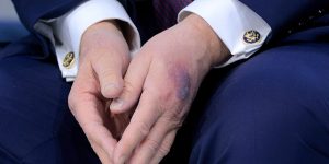 Bruise on Trump's hand explained by White House at Davos event
